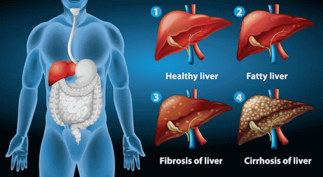 Fatty Liver Disease